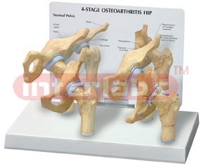 4-Stage Arthritic Hip